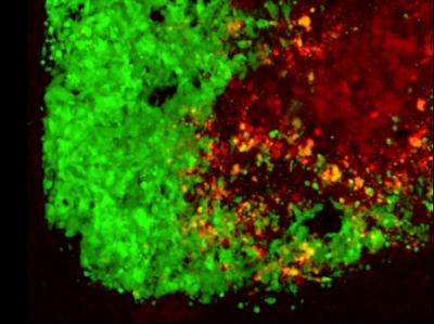 Stem Cells Loaded with Cancer-Killing Herpes Virus Attack a Brain Tumor Cell