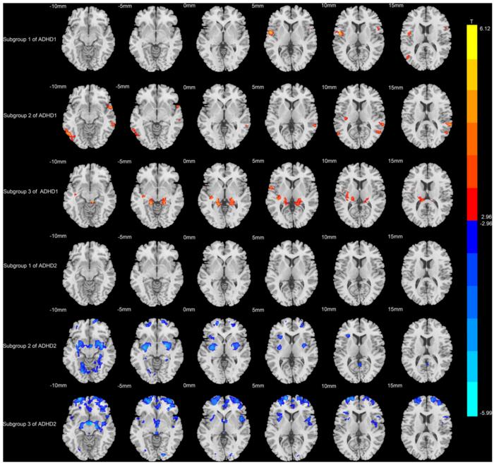 MRI shows different progressive grey matter volume changes in two ADHD subtypes across symptom severity
