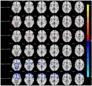 MRI shows different progressive grey matter volume changes in two ADHD subtypes across symptom severity