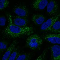 New Drug Squashes Cancer's Last-Ditch Efforts to Survive (1 of 2)