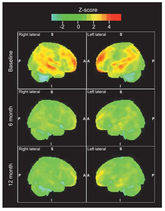 Representative Reduction in Cerebral Amyloid Deposition in a Patient Treated with Lecanemab Over 12 Months