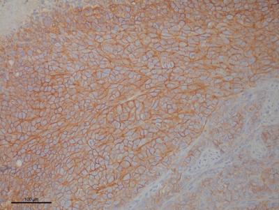 Unique Research Approach Finds FDA Approved Drug Shuts Down Ewing Sarcoma Cells in Lab