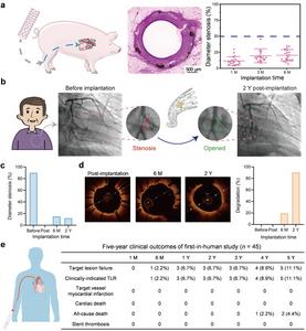 Five-year first-in-human clinical outcomes of the PLA-coated biodegradable iron stent