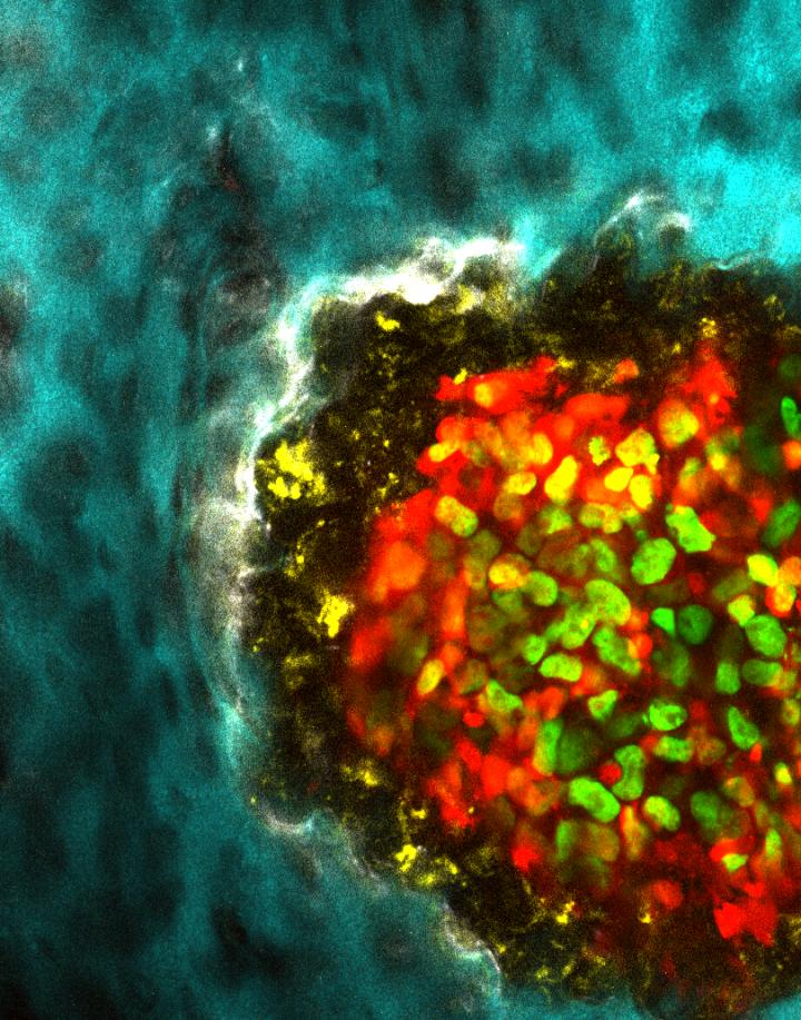 Cancer-Induced Bone Loss
