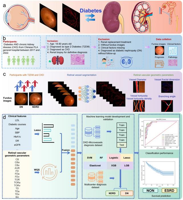 AI workflow and retinal vascular biomarkers for diabetic nephropathy diagnosis and prognosis
