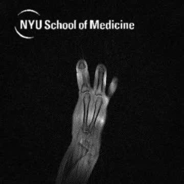 MR Image Shows Hand 'Playing Piano'