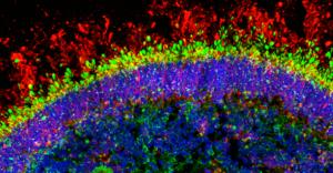 RPGRIP1 disease retinal organoid treated with AAV-RPGRIP1