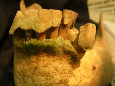 Dental Calculus Example