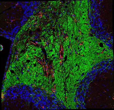 Brain Losing Myelin in MS 