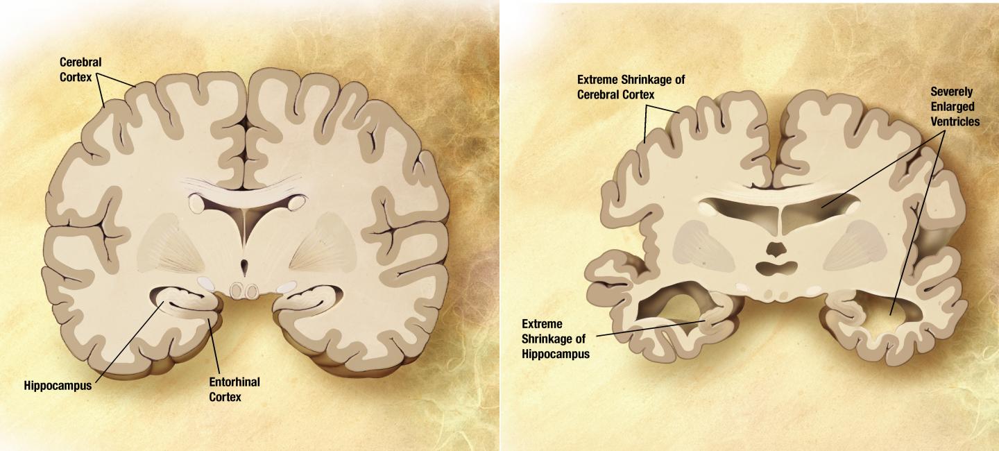 A Healthy Brain and an AD-Affected Brain