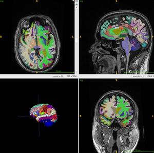 Example of segmented regional volumes obtained from the 3D T1 volumetric MRI scan