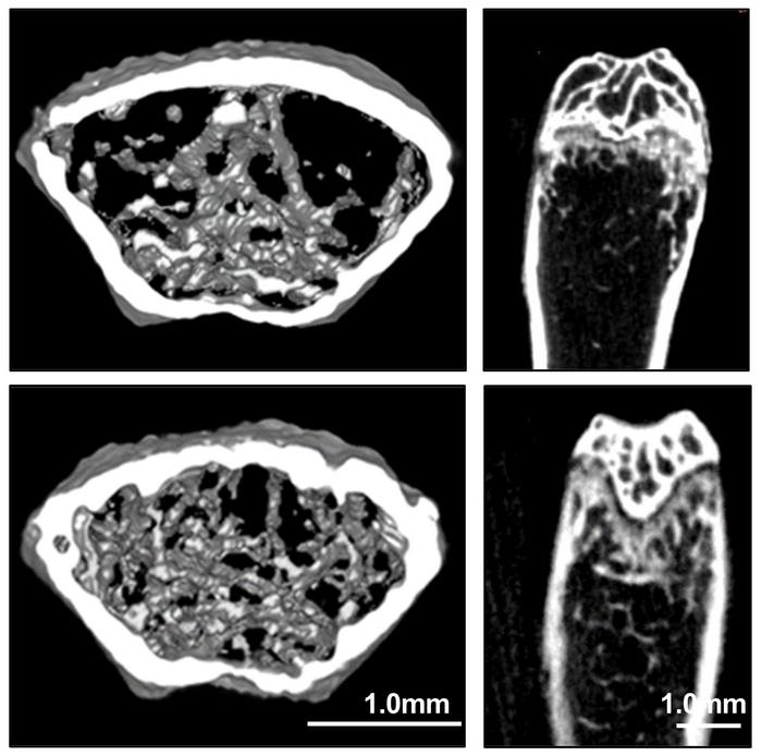 La inteligencia artificial (IA) indica que un fármaco para la malaria podría ofrecer un tratamiento para la osteoporosis