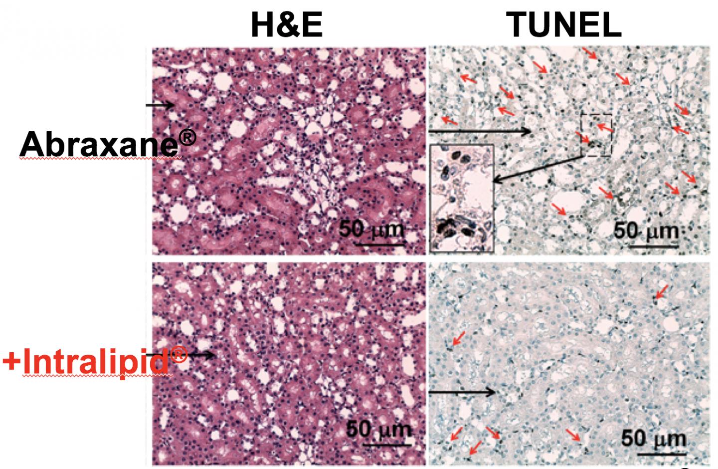 Intralipid Reduces Toxicity of Chemotherapy Nanodrug
