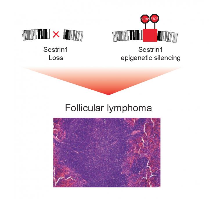 Problems with the Sestrin1 Gene Lie Behind Follicular Lymphoma