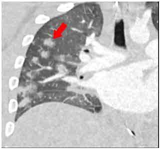 New Study Looks at Post-COVID-19 Emerging Disease in Children