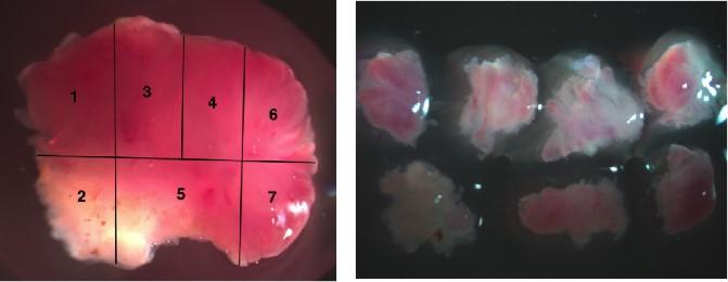 The Team Sampled Multiple Areas of Each Tumor to Measure Intra-Tumor Heterogeneity
