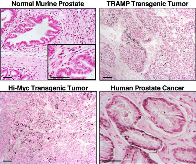 Out-FOXing Prostate Cancer