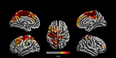 Brain Images Showing Affect of Traffic Related Air Pollution on 12 Year Olds