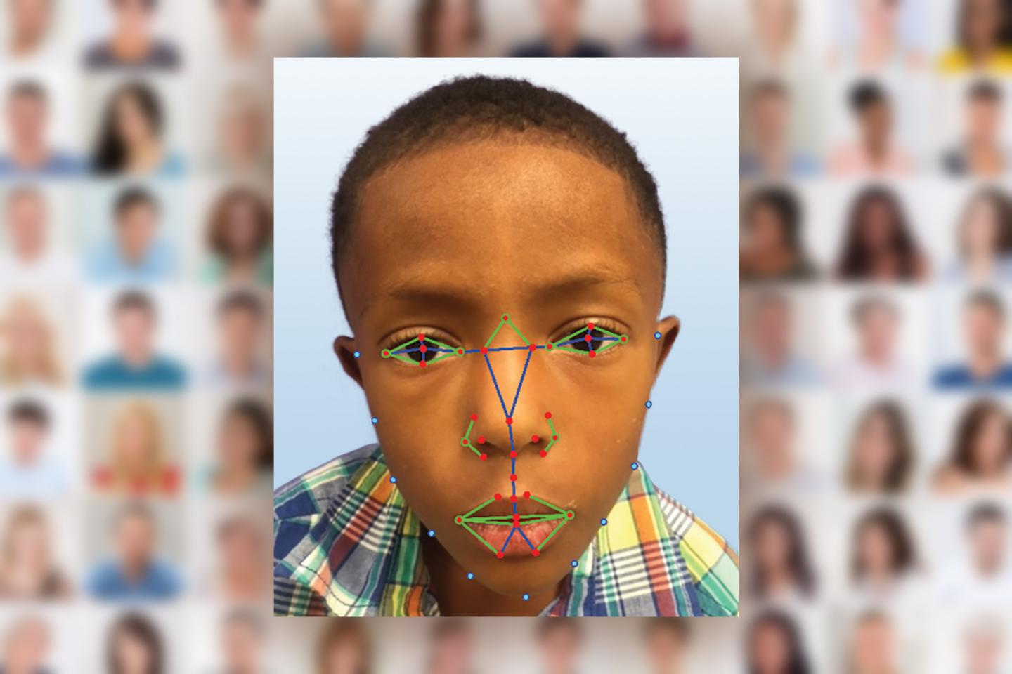 DiGeorge Syndrome