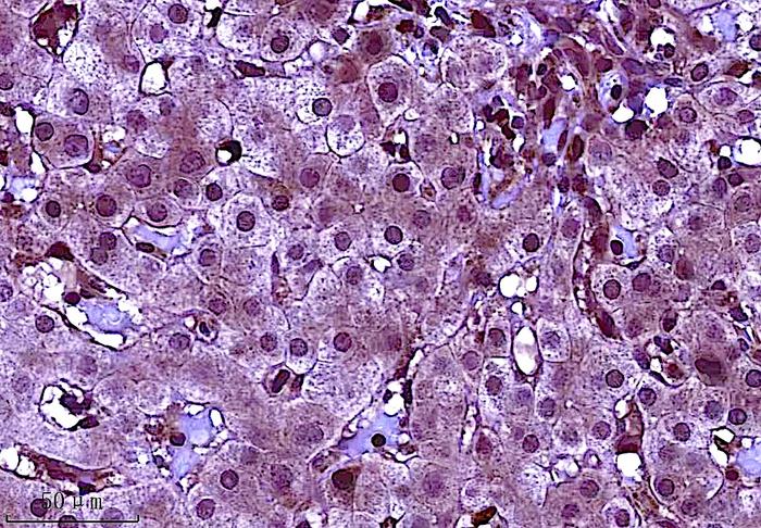 Study Identifies Ways to Lower Risk of Liver Cancer for People with Hepatitis B Infection