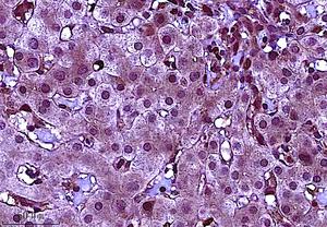 Study Identifies Ways to Lower Risk of Liver Cancer for People with Hepatitis B Infection