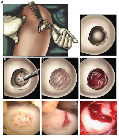 Light-Activated Hydrogel Repairs Cartilage (1 of 1)