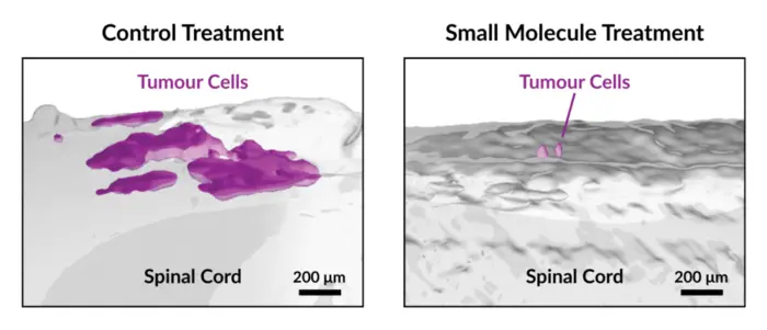 Tumour Reduction Following Treatment