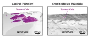 Tumour Reduction Following Treatment