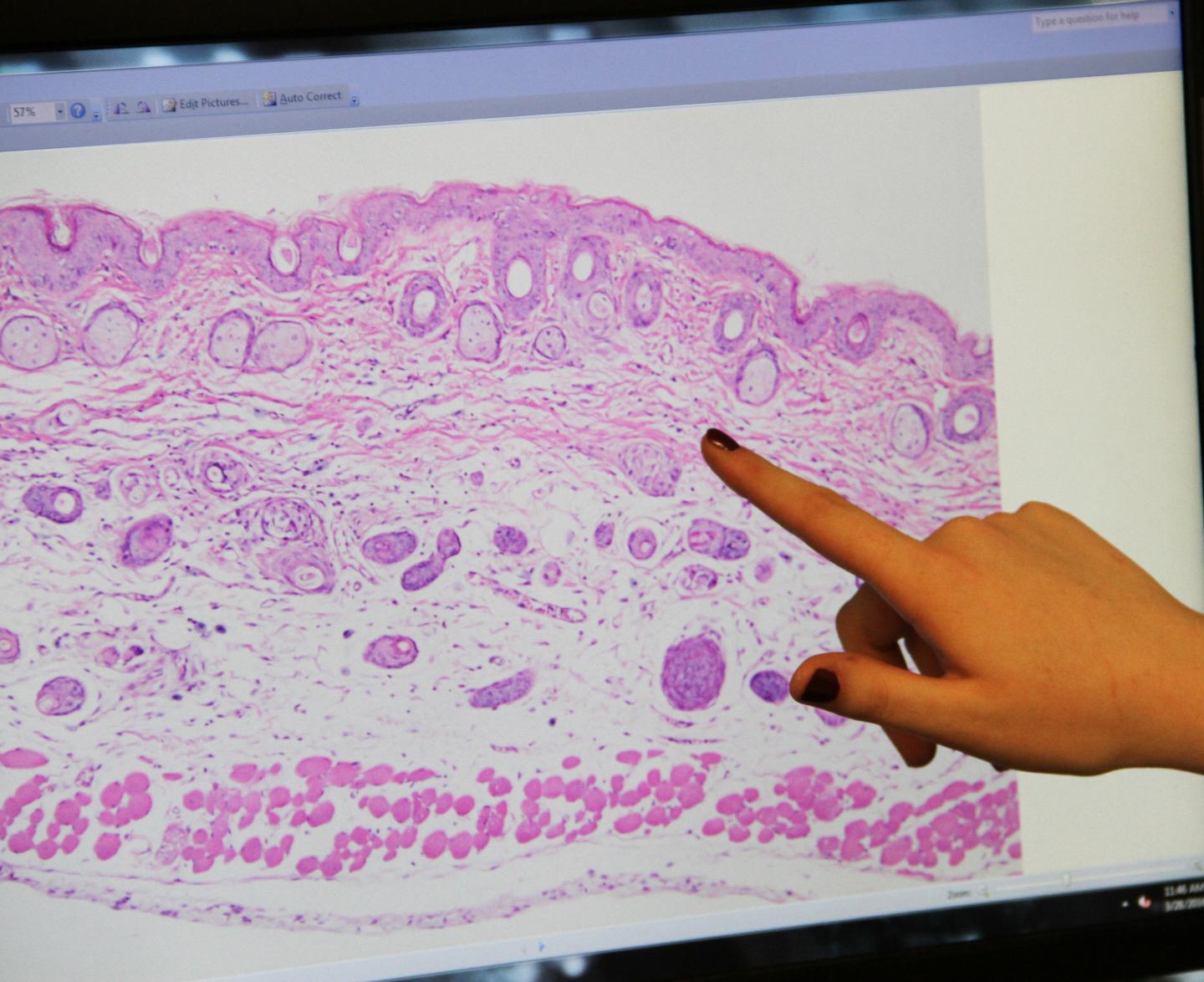 Ohio State Shows that SPF30 Sunscreen Can Reduce Melanoma