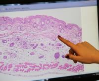 Ohio State Shows that SPF30 Sunscreen Can Reduce Melanoma