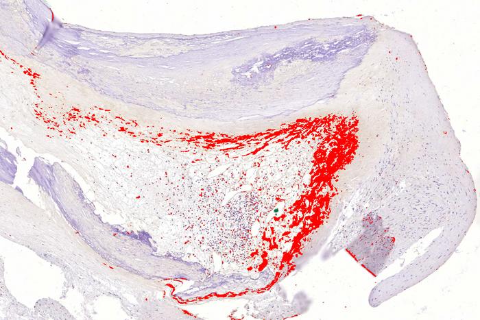 coronary artery