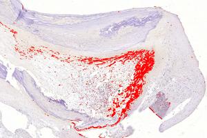 coronary artery