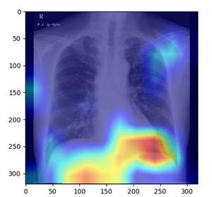 AI decision-making process with chest X-ray images