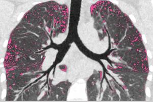 Air trapping in lungs of cystic fibrosis patient treated with CFTR modulator.