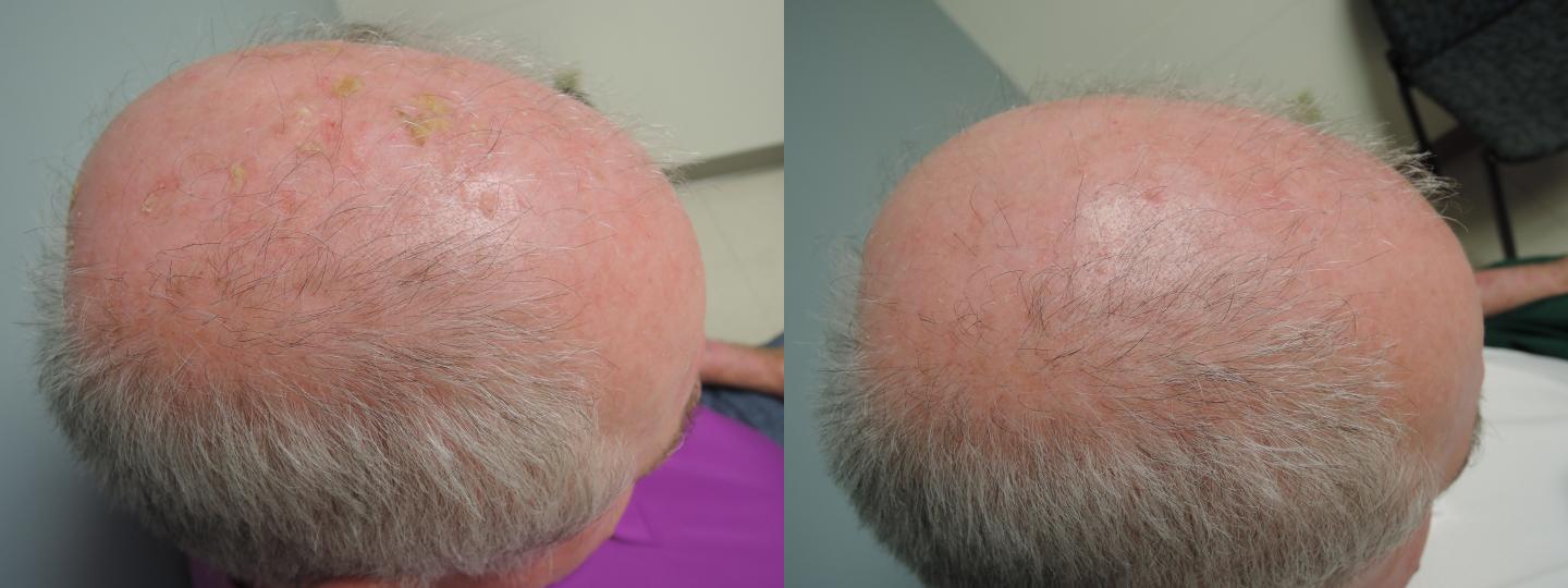 Combination Treatment of Actinic Keratosis
