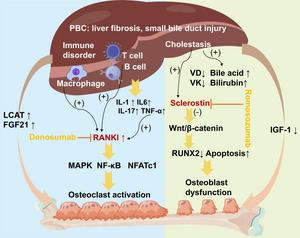 Primary Biliary Cholangitis–associated Osteoporosis