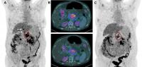 <sup>18</sup>F-FDG PET and CT scans of patient before and after <sup>177</sup>Lu-3BP-227 Therapy