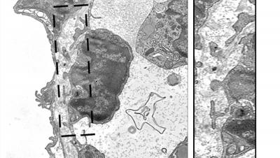 Tumor Cell at the Inner Wall of a Blood Vessel -- A Magnified Image of the Marked Area Is Shown on t