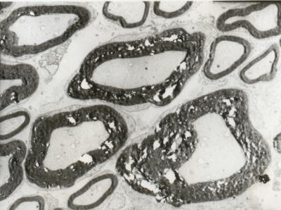 Nerve Axons