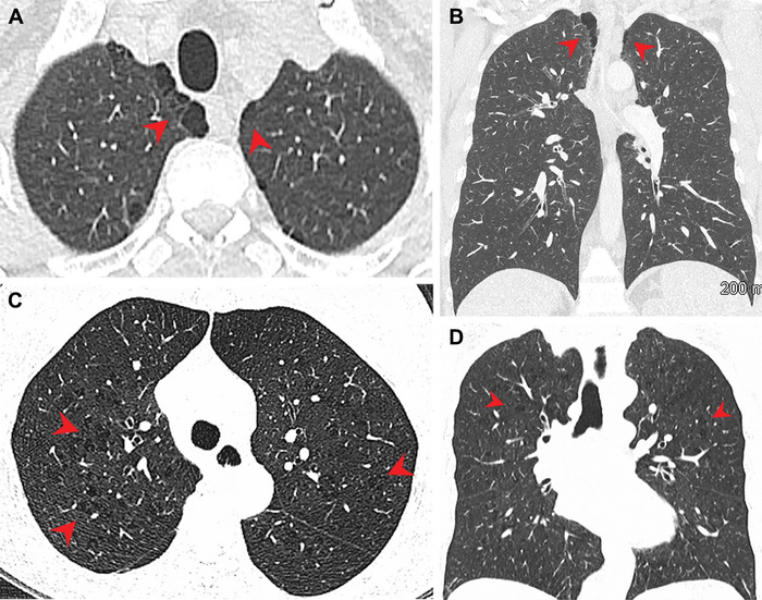 Emphysema More Common in Marijuana Smokers than Cigarette Smokers