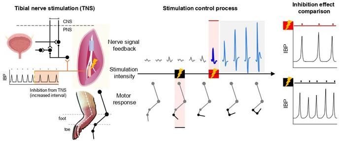 Application to tibial nerve stimulation for urinary regulation and comparison of outcomes