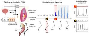 Application to tibial nerve stimulation for urinary regulation and comparison of outcomes