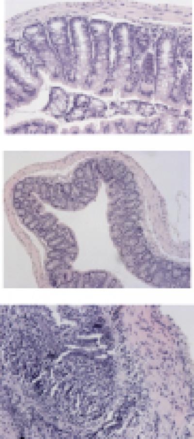 Ulcerative Colitis Tissue