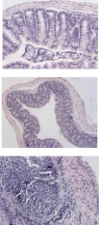 Ulcerative Colitis Tissue