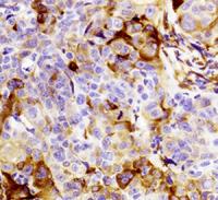 Lung Cancer Cell