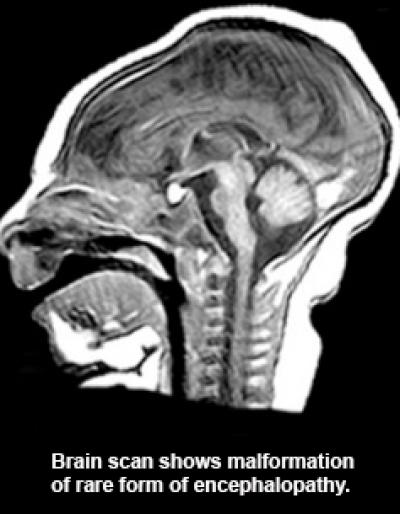Encephalopathy