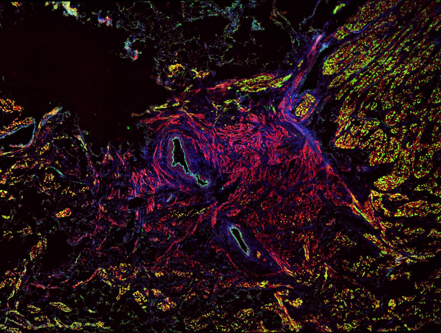 Backup Pacemakers Let the Heart Take a Thumping and Keep on Pumping (3 of 3)