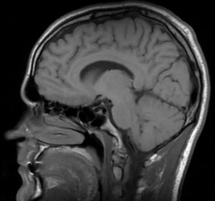 Decoding the Timing Behind Premature Suture Fusion in Craniosynostosis