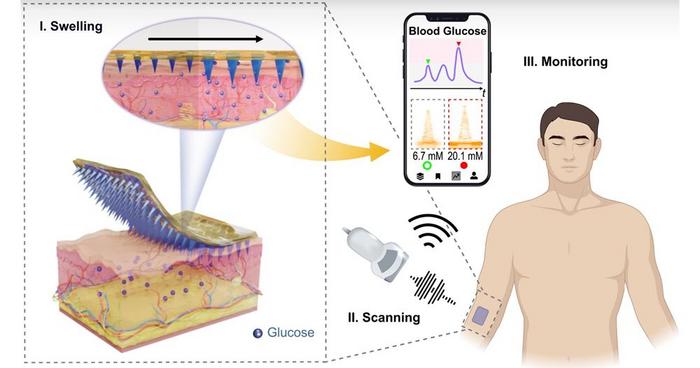 PolyU develops wearable microneedle patch to empower conventional ultrasound for continuous glucose monitoring