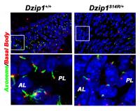 Defects in Cellular Antennae Can Cause a Common Heart Condition (3 of 3)